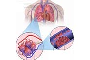 Chẩn đoán và xử trí tắc động mạch phổi cấp