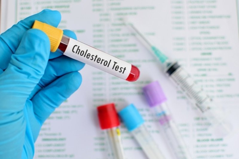 Ống máu ghi nhãn "Cholesterol Test" trên phiếu chỉ định xét nghiệm