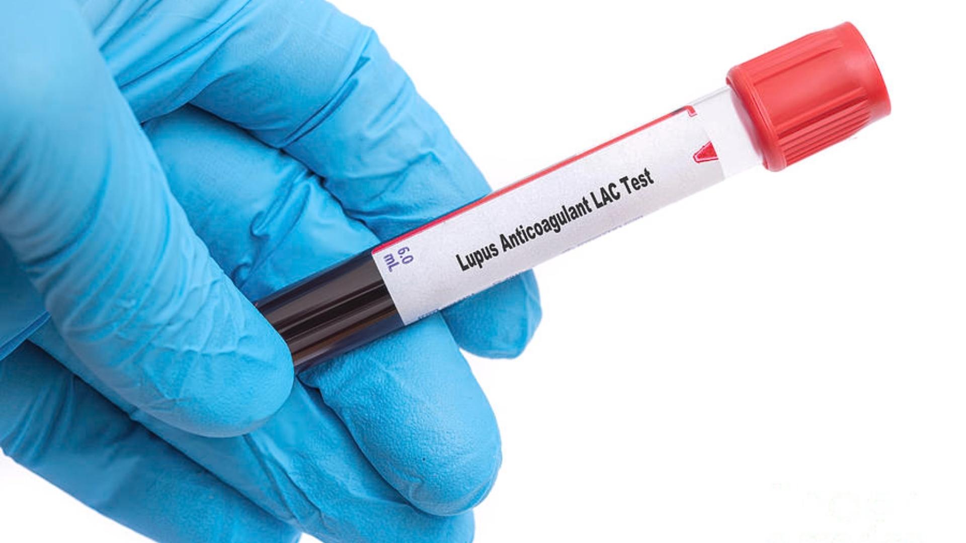 Bàn tay đeo găng cầm ống máu ghi nhãn "Lupus Anticoagulant LAC Test"