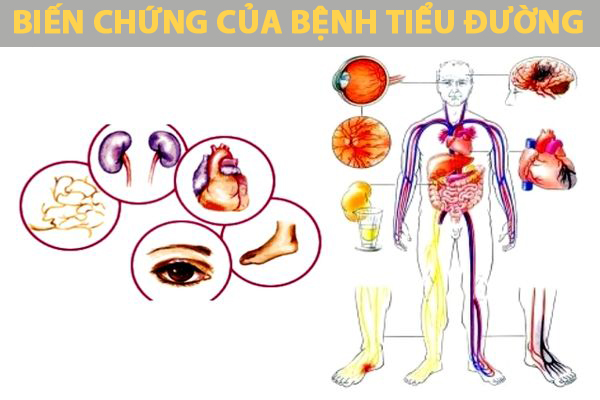 Hình minh họa biến chứng của bệnh tiểu đường lên mắt, não, tim, thận, mạch máu và bàn chân