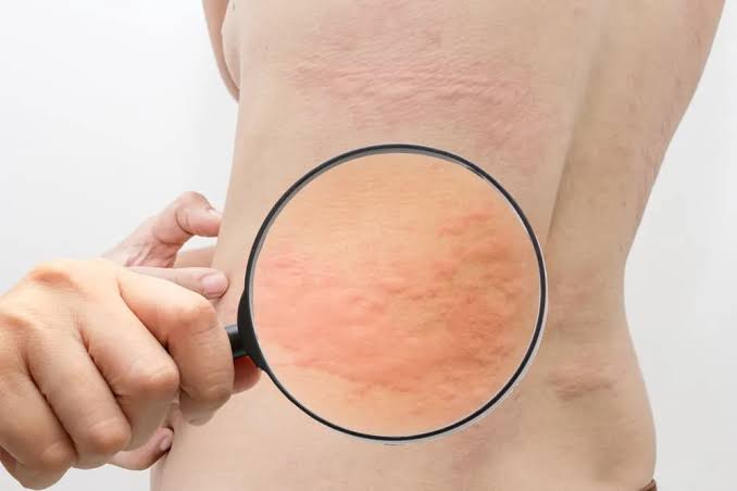 TÌM HIỂU LÝ DO VÌ SAO BỊ MỀ ĐAY VÀ LỜI KHUYÊN Y KHOA