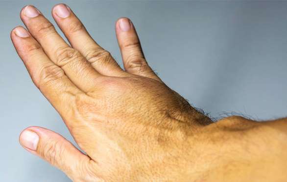 Bàn tay bị sưng nề, một dấu hiệu có thể do cục máu đông