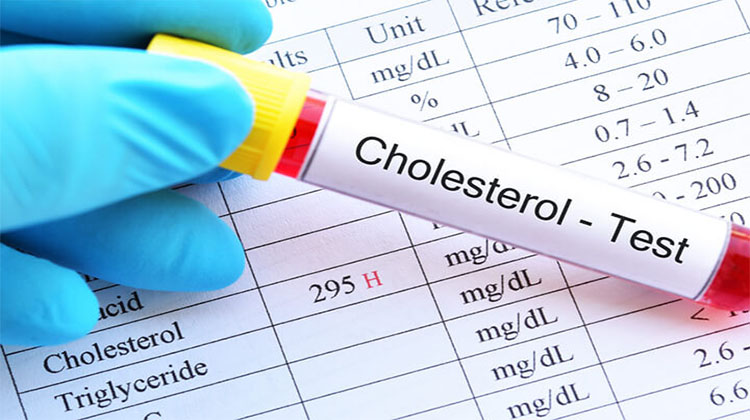 Ống mẫu máu ghi "Cholesterol - Test" trên phiếu kết quả xét nghiệm mỡ máu