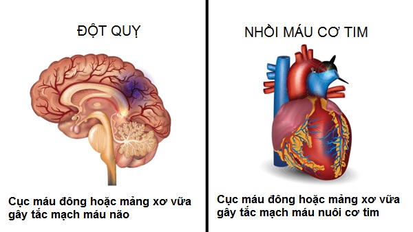 Hình minh họa đột quỵ và nhồi máu cơ tim do cục máu đông hoặc mảng xơ vữa gây tắc mạch máu não và mạch máu nuôi cơ tim