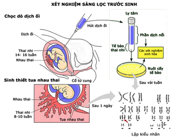 Sơ đồ xét nghiệm sàng lọc trước sinh: chọc dò dịch ối và sinh thiết tua nhau thai để nuôi cấy tế bào, lập kiểu nhân